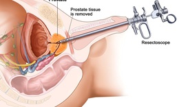 C&#225;ch đẩy l&#249;i u xơ tiền liệt tuyến kh&#244;ng cần mổ