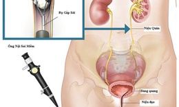 Đẩy l&#249;i sỏi thận - phương ph&#225;p n&#224;o tiết kiệm m&#224; hiệu quả?