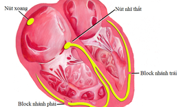 Bệnh block nh&#225;nh phải l&#224; g&#236; v&#224; phương ph&#225;p gi&#250;p ổn định nhịp tim