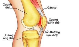 Giảm đau nhức khớp gối theo c&#225;ch của người Nhật