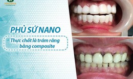 Phủ sứ thẩm mỹ bằng Composite: Coi chừng tiền mất tật mang