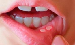 Hiểu đúng về nhiệt miệng để xử trí hiệu quả