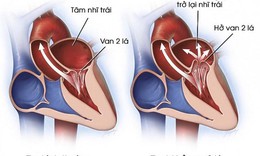 Những điều bạn n&#234;n biết về hở van tim 2 l&#225;