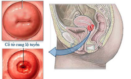 Vi&#234;m lộ tuyến độ 1 v&#224; 7 điều cần biết về bệnh n&#224;y