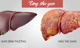 Căn bệnh có tỷ lệ mắc mới cao nhất hiện nay- ung thư gan đang là hiểm họa top 1