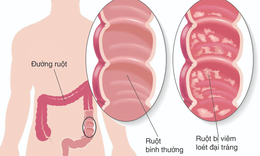 Vi&#234;m đại tr&#224;ng mạn t&#237;nh: triệu chứng, nguy&#234;n nh&#226;n, ph&#242;ng v&#224; điều trị bệnh