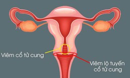 Nguy cơ v&#244; sinh v&#236; vi&#234;m lộ tuyến cổ tử cung