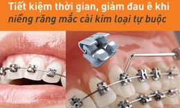 Niềng răng kim loại tự buộc - Giải ph&#225;p tiết kiệm chi ph&#237;, &#237;t đau nhức