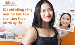 Niềng răng mắc c&#224;i kim loại cho răng thưa: N&#234;n hay kh&#244;ng?