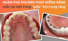 Niềng răng mặt trong gi&#225; bao nhi&#234;u?