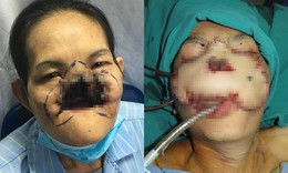 Kỳ tích tái tạo khuôn mặt cho nữ bệnh nhân bị ung thư cụt mũi