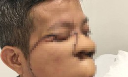 Tái tạo khuôn mặt cho người đàn ông ung thư da 10 năm không dám ăn cơm cùng con, cháu