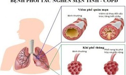 37,5% người trưởng th&#224;nh ở Việt Nam mắc bệnh phổi tắc nghẽn mạn t&#237;nh c&#243; triệu chứng nghi&#234;m trọng