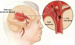 Cảnh b&#225;o: Cụ b&#224; đột quỵ n&#227;o v&#236; tin “tập luyện của gi&#225;o ph&#225;i lạ kh&#244;ng cần d&#249;ng bất cứ thuốc n&#224;o&quot;