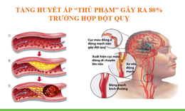 Xu hướng mới trong xử l&#253; đẩy l&#249;i tăng huyết &#225;p v&#224; ph&#242;ng ngừa đột quỵ