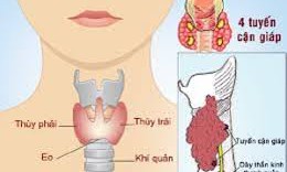 Điều trị ung thư tuyến giáp bằng I-131 cần biết