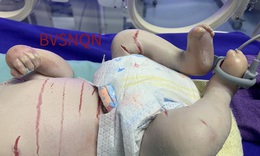 Bé sinh non 32 tuần tuổi mắc bệnh vẩy cá hiếm gặp với nhiều vết nứt trên da