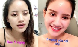 Cắt mí và những điều cần lưu ý