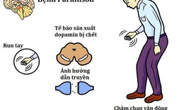 C&#225;ch nhận biết sớm dấu hiệu Parkinson