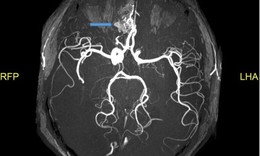 Ph&#225;t hiện tổn thương n&#227;o ở bệnh nh&#226;n COVID-19 qua MRI