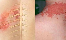 Thuốc điều trị vi&#234;m da tiếp x&#250;c do c&#244;n tr&#249;ng
