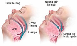 Phẫu thuật - Phương ph&#225;p khả thi để điều trị chứng ngưng thở khi ngủ