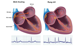 Rượu l&#224;m tăng biến cố bất lợi ở bệnh nh&#226;n rung nhĩ