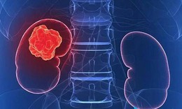 Thuốc mới trị ung thư thận tái phát: Phòng ngừa bất lợi của thuốc