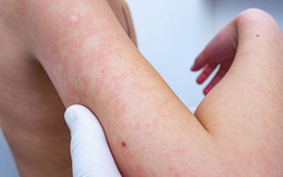 Rôm sảy: Nguyên nhân, triệu chứng, phòng ngừa và điều trị