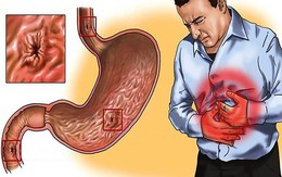 Câu hỏi thường gặp liên quan đến loét dạ dày tá tràng