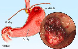 Các thuốc điều trị loét dạ dày tá tràng