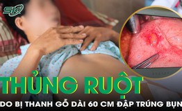 Nam c&#244;ng nh&#226;n thủng ruột do thanh gỗ d&#224;i 60cm đập tr&#250;ng bụng