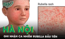 Ghi nhận ca mắc rubella đầu ti&#234;n tại H&#224; Nội trong năm 2024 