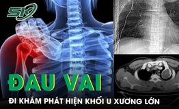 Đau tức nhẹ v&#249;ng vai, đi kh&#225;m ph&#225;t hiện khối u xương k&#237;ch thước lớn 