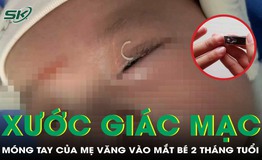 B&#233; 2 th&#225;ng tuổi trầy xước gi&#225;c mạc v&#236; mẹ bấm m&#243;ng tay văng v&#224;o mắt