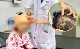 B&#233; g&#225;i 5 tuổi ở H&#224; Nội bị ch&#243; nh&#224; nặng 20kg cắn r&#225;ch đầu, mặt