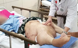 Khối u xơ thần kinh khổng lồ g&#226;y biến dạng ch&#226;n bệnh nh&#226;n 78 tuổi