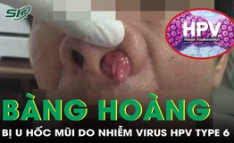 Người đ&#224;n &#244;ng bị u hốc mũi do nhiễm virus HPV type 6
