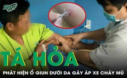 Kinh h&#227;i h&#236;nh ảnh giun rồng chui l&#234;n qua da, ph&#225;t hiện nhiều ổ giun &#225;p xe khắp cơ thể 