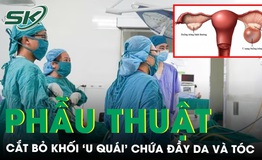 Kh&#225;m sức khoẻ b&#224;ng ho&#224;ng ph&#225;t hiện khối ‘u qu&#225;i’ chứa đầy da v&#224; t&#243;c