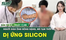 Bản Tin Y Tế 11/8: Người đ&#224;n &#244;ng bỏng nặng, m&#249; tạm thời do dị ứng silicon