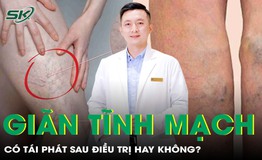 Gi&#227;n tĩnh mạch c&#243; t&#225;i ph&#225;t kh&#244;ng? Sự thật về căn bệnh nhiều người chủ quan