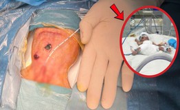 Bé trai sinh non 700 gram thủng ruột tự phát đặc biệt nguy kịch