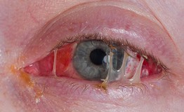 Sáng ngủ dậy hai mắt dính như keo, cụ bà phát hiện túi lệ đầy mủ