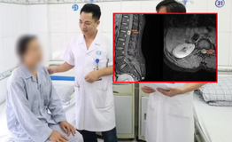Đau lưng đến mất ngủ, người phụ nữ 39 tuổi đi khám phát hiện u tủy