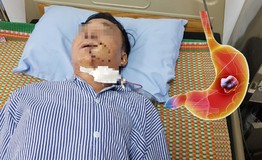 Người đàn ông 50 tuổi bàng hoàng phát hiện ung thư sau thời gian dài hôi miệng