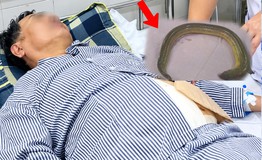 Người đàn ông 55 tuổi đau bụng dữ dội, bác sĩ gắp lươn sống dài 65 cm