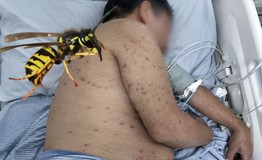 Người đàn ông 62 tuổi suýt chết vì bị ong đốt 300 nốt