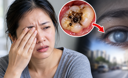 Người phụ nữ 35 tuổi suýt mất thị lực vì ổ sâu răng lâu năm