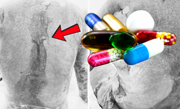 Dùng thuốc trị gout, người bệnh hoại tử da, nguy kịch tính mạng
